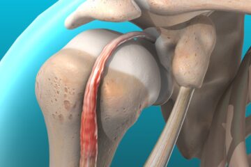 Tendinitis