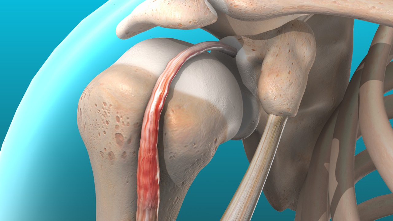 Tendinitis
